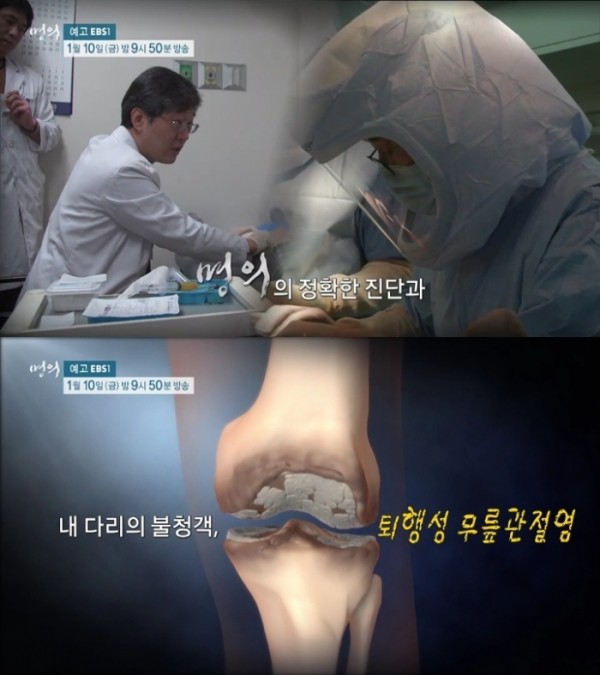 'Mine' degenerative knee arthritis, artificial joint from 65 years old