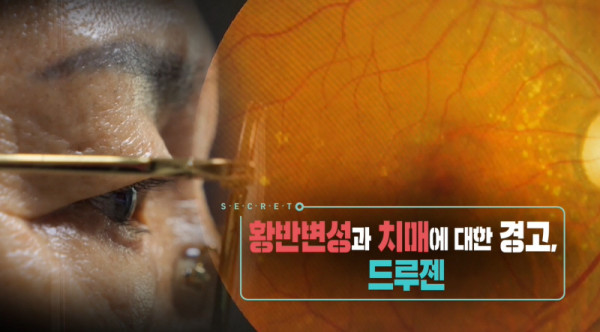 <Secrets of birth, old age, illness, and death> Warning about macular degeneration and dementia, ‘drusen’